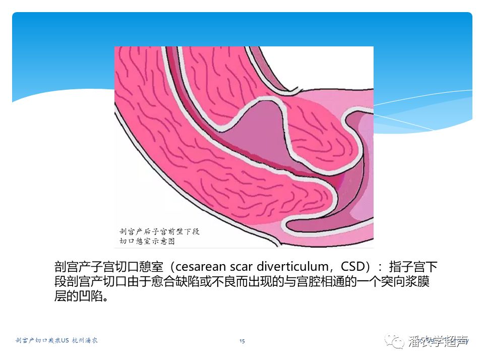 剖宫产切口消毒图解图片