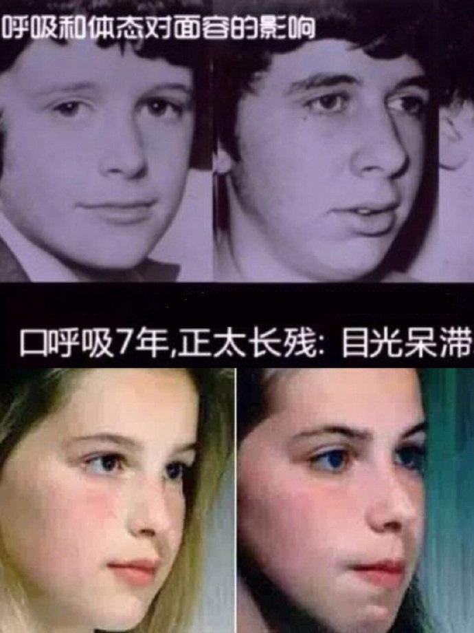 8715牙齿前突&鼻部疾病为什么会口呼吸 ?