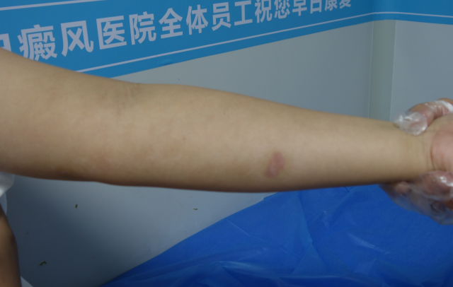 白癜风患者真实案例分析11岁男孩上肢白斑治疗周期图片对比