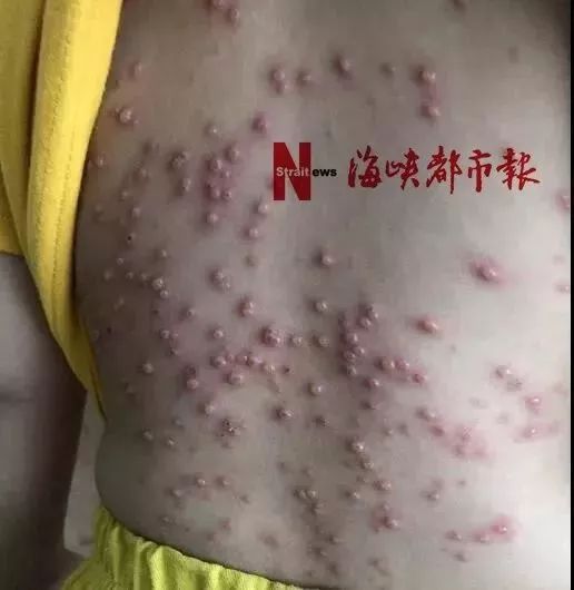 王滔主任解释,小明得的是一种由柯萨奇病毒a组6型病毒(即cv-a6病毒)