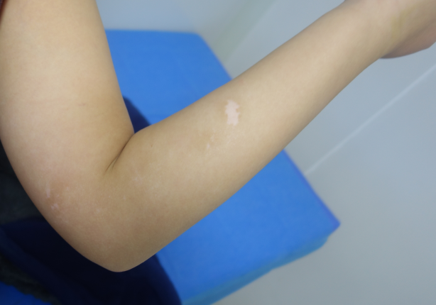白癜风患者真实案例分析11岁男孩上肢白斑治疗周期图片对比