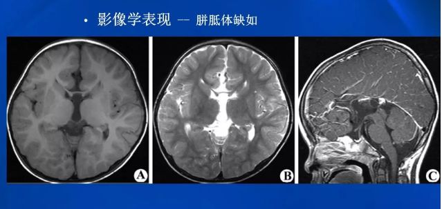 胼胝体缺失的遗传咨询