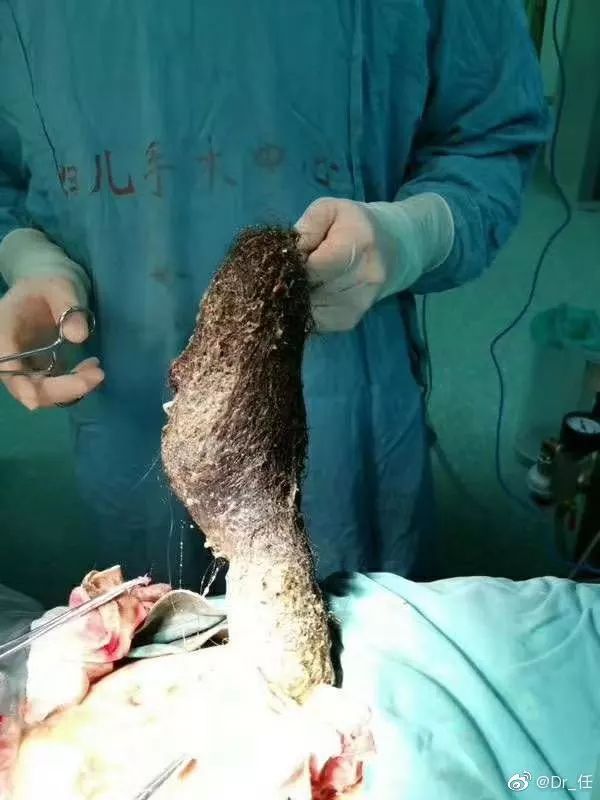 【注意】青岛13岁女孩肚子里全是头发!家长一定要警惕