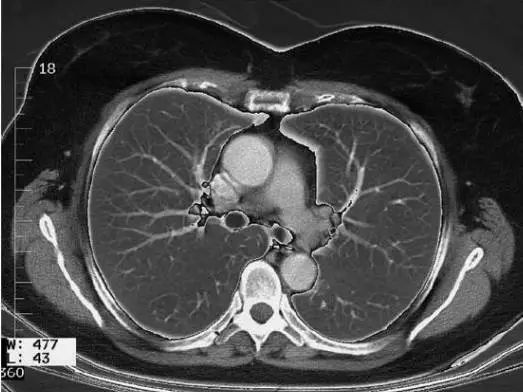 胸腺横断面图片