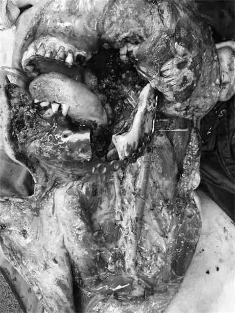 槟榔口腔癌图片晚期图片