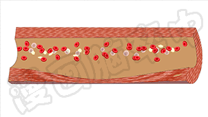 的冲击越大而血压持续较高水平不能控制时,也会加重血管的粥样硬化