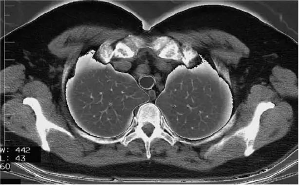 胸腺横断面图片
