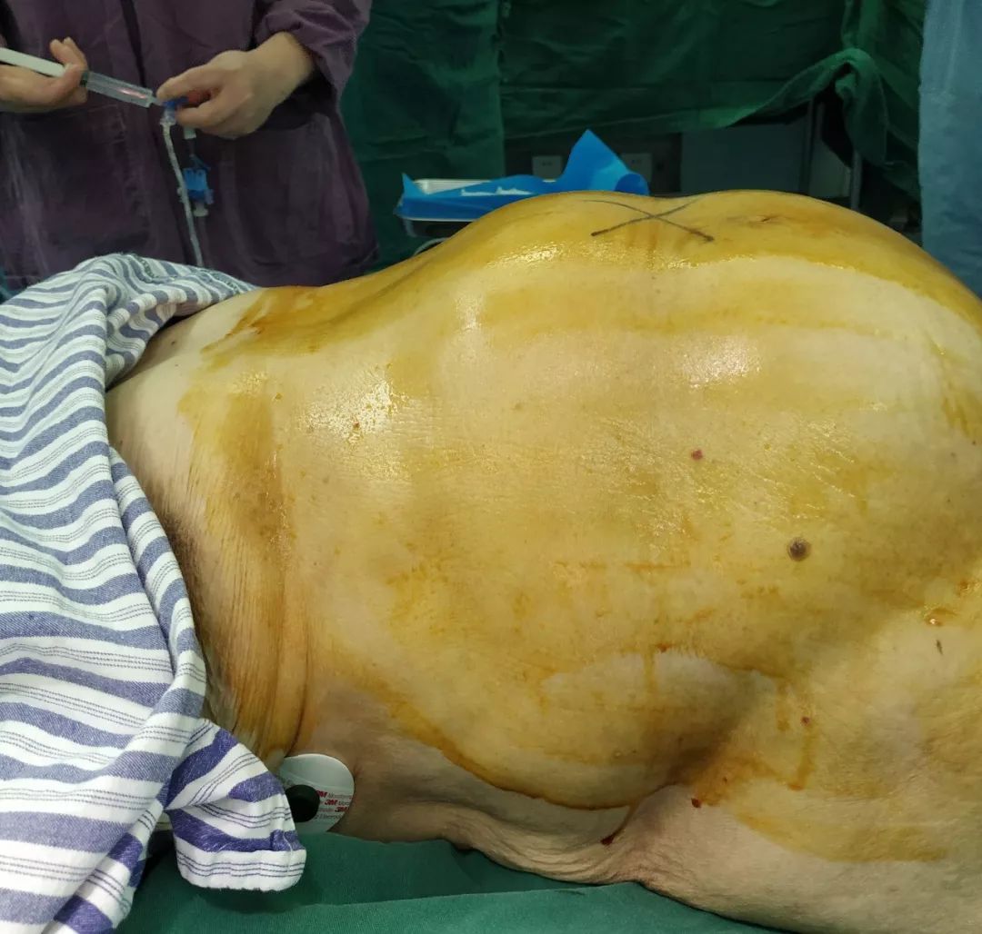 86岁娭毑肚子忽然增大,打开后手术医生惊呆了