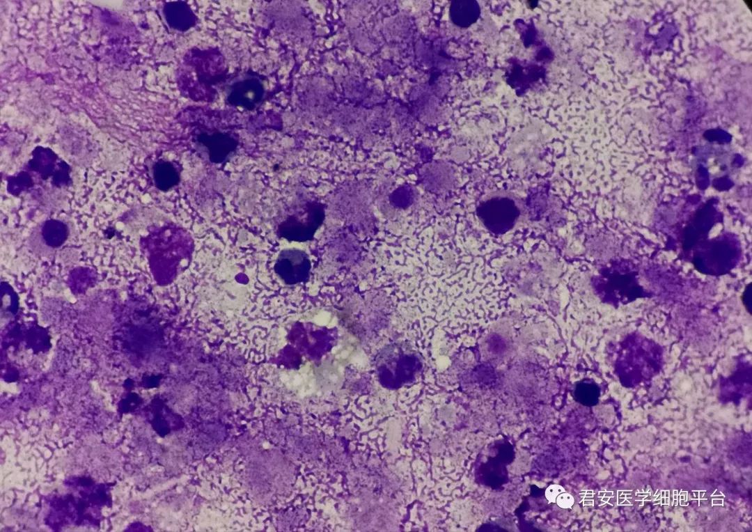 糖尿病患者积液的间皮细胞往往都是退化的间皮比较多(肝硬化,动脉粥样