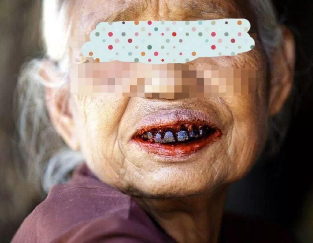 长期吃槟榔的口腔照片图片