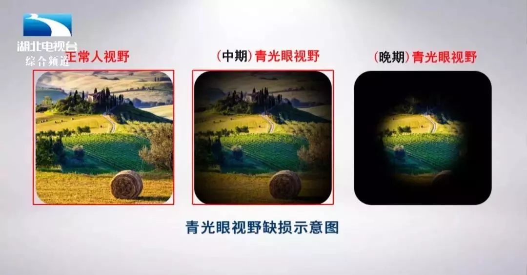 是一种以特征性视神经萎缩和视野缺损为表现的疾病