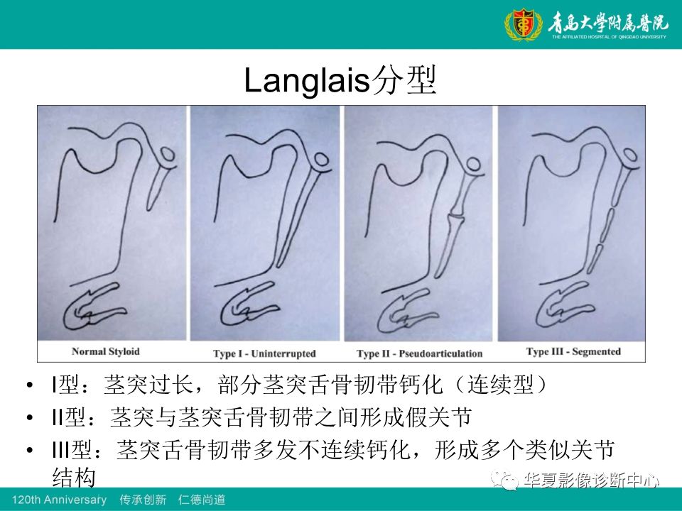 扁桃体茎突过长图片图片