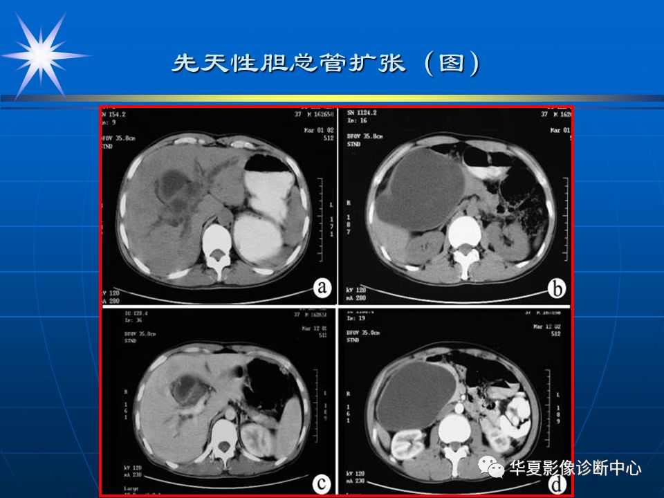 胆管ct正常图解图片