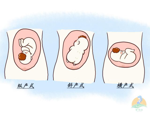 胎产式分类①横产式:胎儿脊柱方向和产妇脊柱方向呈现垂直状"t"字