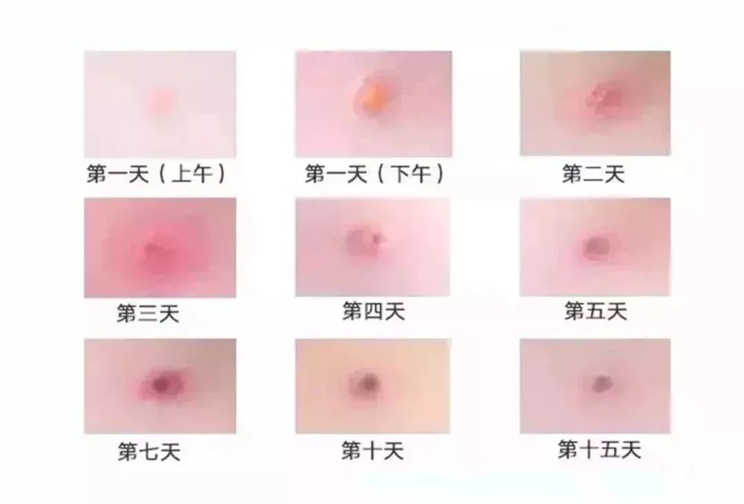 如何辨认水痘图片