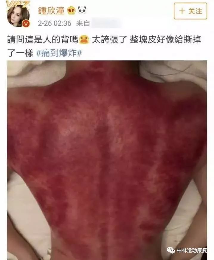 刮痧,拔罐的致命谎言,骗了多少中国人!
