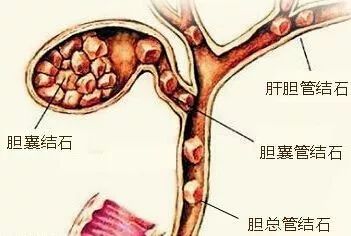 肾结石,胆结石,胃结石…人体怎么有这么多石头!快看看你有没有