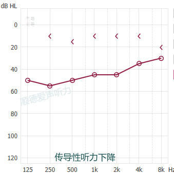 传导性耳聋听力图图片