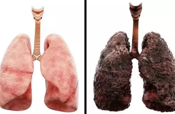 吸烟是导致肺癌的主要原因,90%以上的肺癌主要是吸烟或者被动吸二手烟