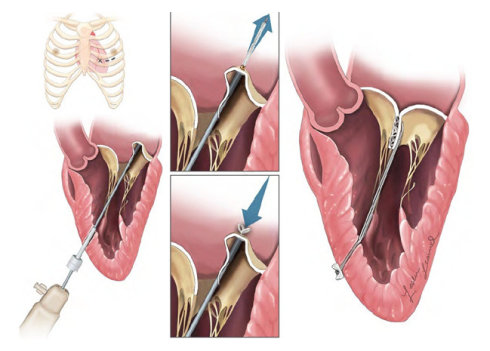 二尖瓣返流的介入治疗
