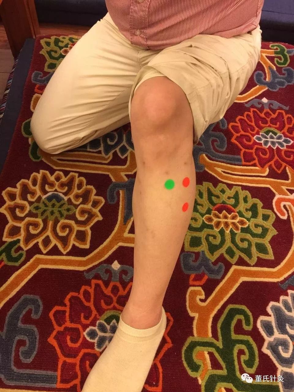 董氏针灸林正泰案例分享之【側三里,側下三里穴】