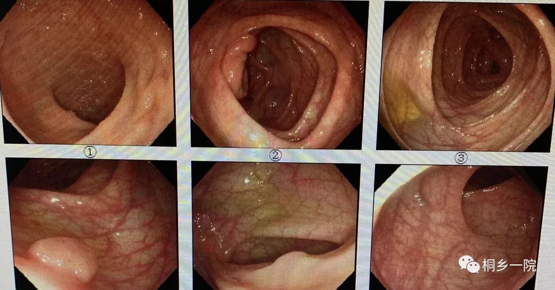 小芳接受了肠镜检查,果然发现结肠部位有两处肠息肉.