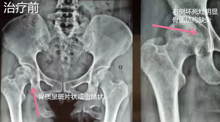 酒精性股骨頭壞死保髖康復案例紀實