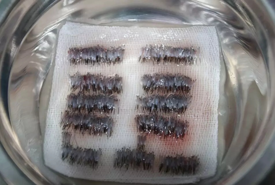 世界东方舞亚军李慧在深圳青逸植发医院的植发现场直播