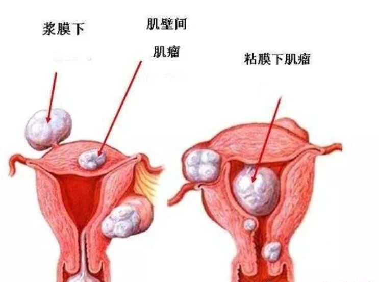 说到症状,就必须说说子宫肌瘤的分型了,按照子宫肌瘤生长的位置以及与