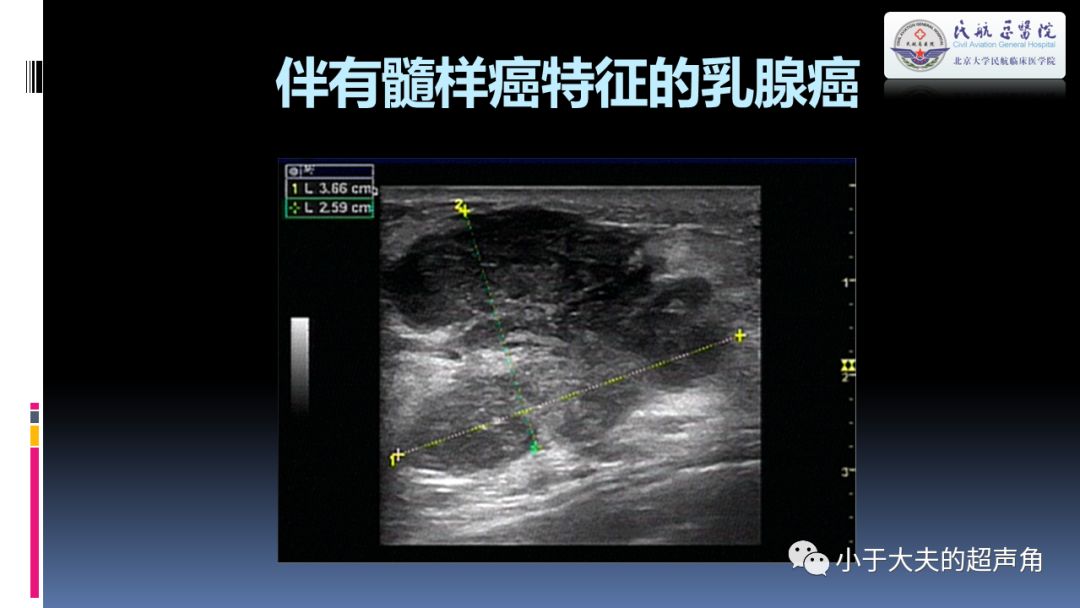 14,具有大汗腺特徵的浸潤性癌(兩例).15,乳腺葉狀腫瘤.