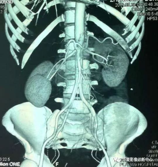 温故知新肾下垂与游走肾