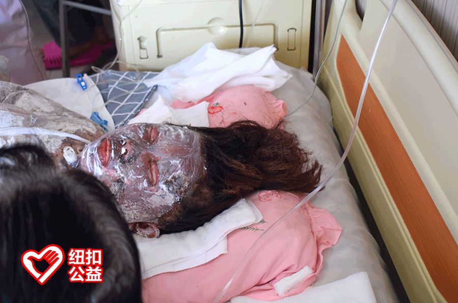 青县上伍乡上伍村,突发煤气罐爆炸,36岁妈妈全身95%深度烧伤!