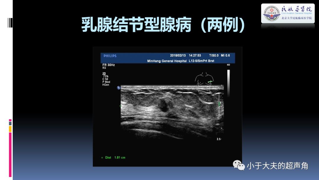 超声乳腺疾病欣赏