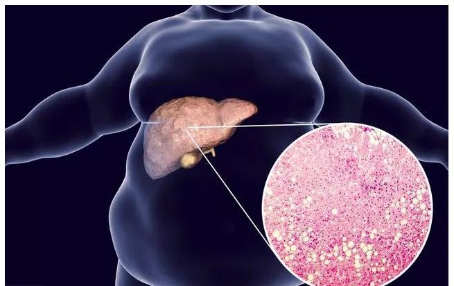 体检查出脂肪肝,饮食上坚持这2件事就行!不出1月,多余脂肪消失