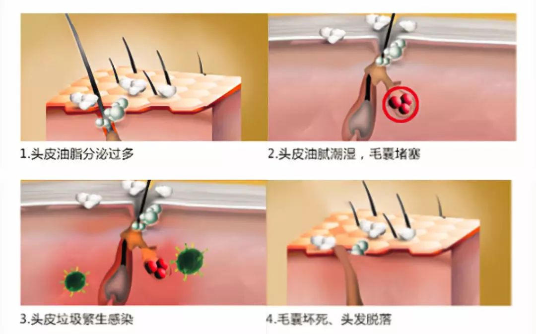 造成毛囊萎缩,头发脱落