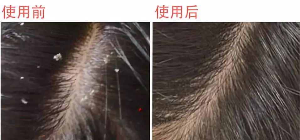 拯救你的发际线,头发越梳越多,唤醒毛囊新生,摆"脱"烦恼