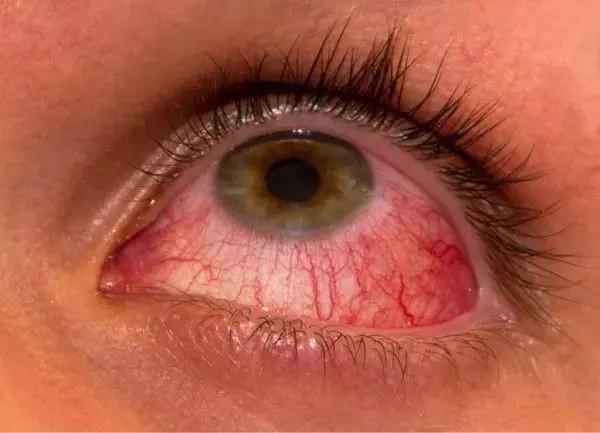 葡萄膜炎初期的症状和红眼病很相似,但葡萄膜炎是致盲的眼病,严重的