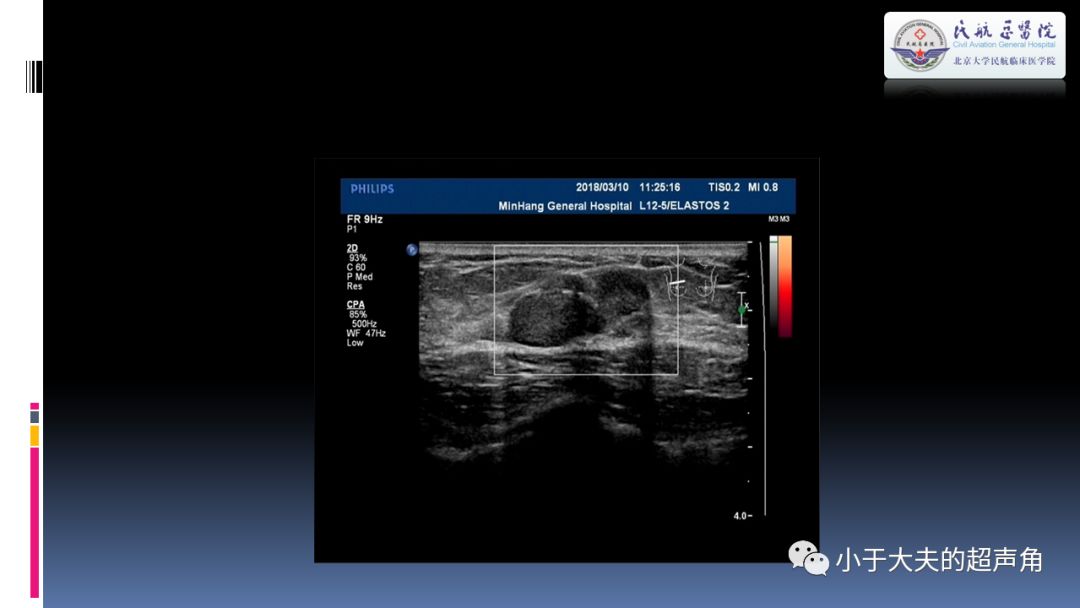 超声乳腺疾病欣赏