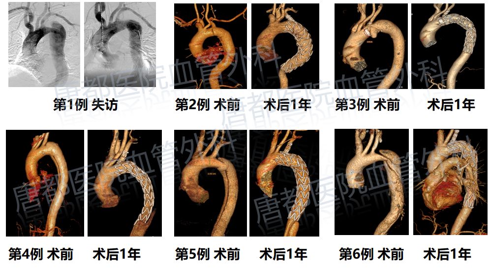 数据总结空军军医大学唐都医院血管外科运用castor03分支型支架一年