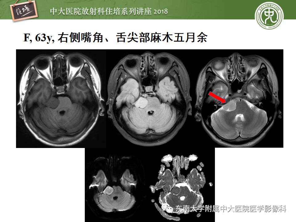 中大放射住培系列讲座第64期成人桥小脑角区占位性病变影像诊断思路