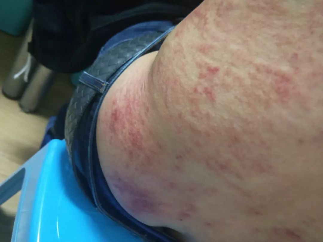 脾虚-李道政虎符铜砭辨证配穴案例解析