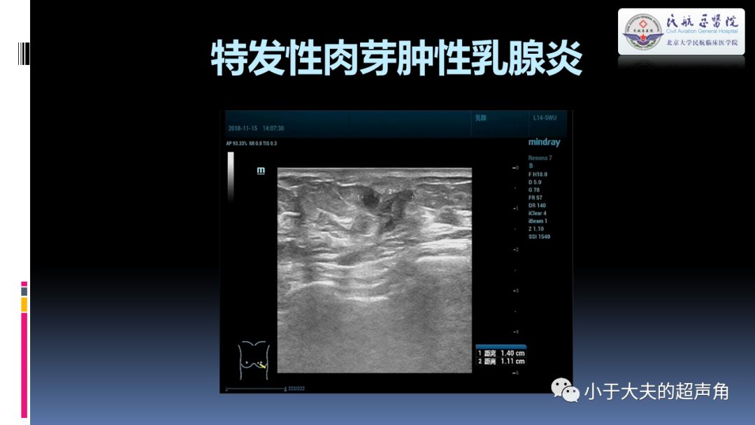 1,漿細胞性乳腺炎(乳腺導管擴張症)(標題是可以點擊的喔)走起!