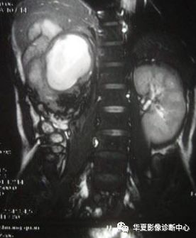 温故知新肾下垂与游走肾
