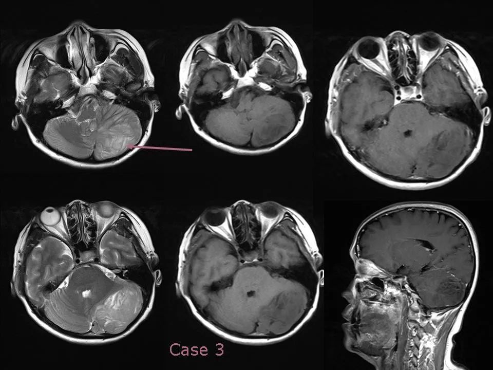 小脑发育不良性节细胞瘤的mr诊断 