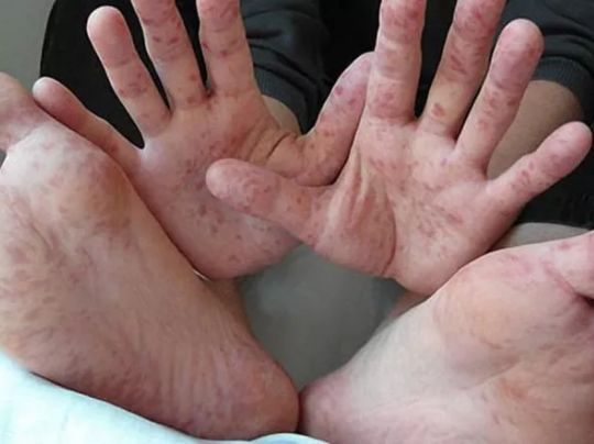 紧急提醒天门人注意了这种病毒出现新症状近期进入感染高发季