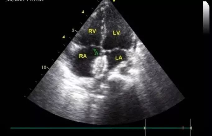科普谈谈结构性心脏病