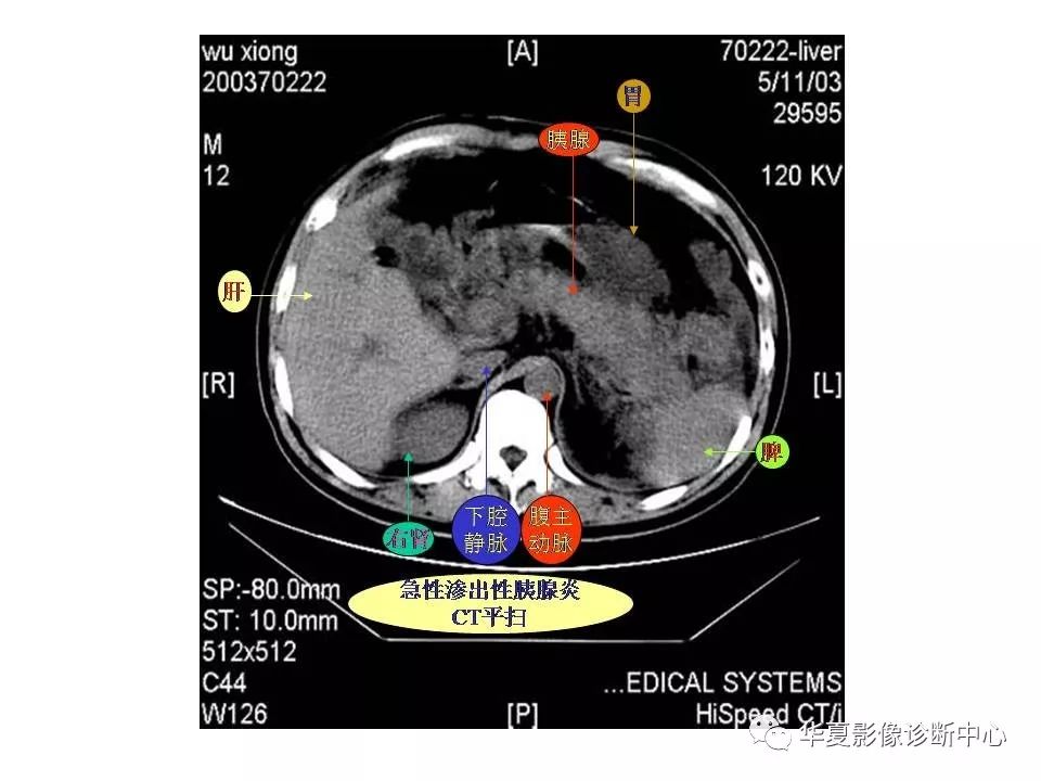 影像基础腹部ct断层解剖