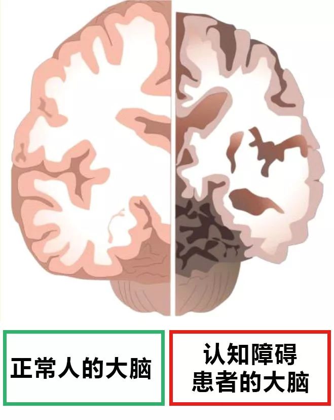 认知障碍到底离你有多远