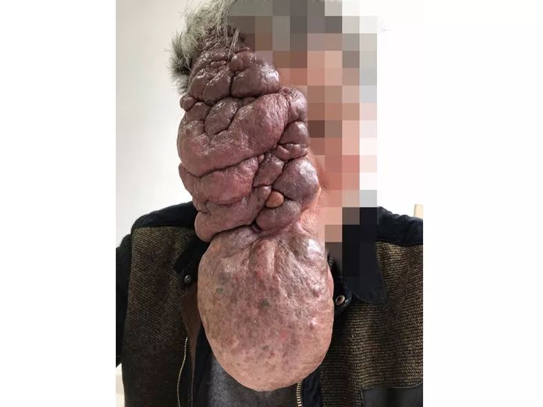 切除巨大瘤体的9h换脸手术和背后优秀的整形外科医生