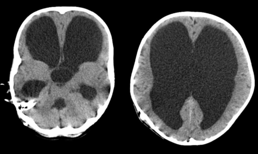 小儿脑积水后巨颅矫形一例(小儿神经外科系列九)